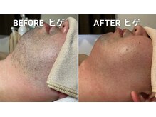 サロン アムール(salon Amour)/髭脱毛