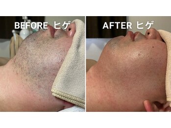 サロン アムール(salon Amour)/髭脱毛