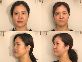 フラット(FURATTO)/Before - After【施術約10回】