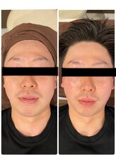 レヴィオ(REVIO)/フェイシャルスリム