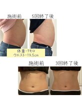 リメレ(Rimere)/寝ているだけでこの変化！