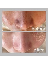 ダリア(DAHLIA)/毛穴洗浄／ハイドラフェイシャル