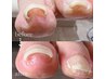まずはご相談ください☆巻き爪・変形爪・厚爪などのカウンセリング