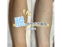 サロン(SALON)/メンズ脱毛：腕