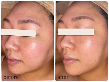 ベル(Bell)/光フェイシャルで速攻小顔！