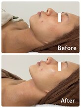 フェイシャルエステ エムズルーム(M's room)/肌に優しいフォト＆プラセンタ