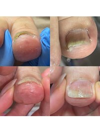 痛みがある巻き爪補正