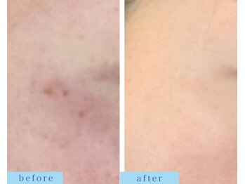 アフロディーテ(APHRODITE)/ビフォーアフター