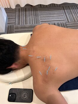 イワモト 水戸院(IWAMOTO)/背部のはりきゅう施術