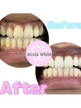 エクシアホワイト 平岸駅前店/ホワイトニングビフォーアフター