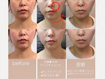 ブリエ(Briller)/フィジオショット