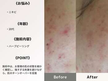 ルディラ医療提携エステ 立川店 毛穴/小顔/ニキビ・シミ・美白・シワ・たるみケア/ハーブピーリング