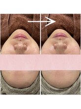 アイリーン(IRENE)/スペシャルケアで肌質改善♪