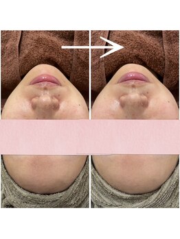 アイリーン(IRENE)/スペシャルケアで肌質改善♪