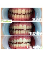 ルブラン 奈良店(Le Blanc)/照射6回で白い歯に！！