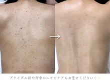フェイシャルヴィム(FACIAL VIM)の雰囲気(人気の背中ケア/ブライダル前は余裕をもったご予約を)