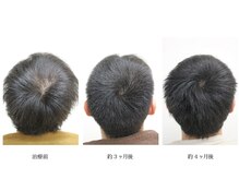 メンズ asc(men's asc)/ヘッドスパ2