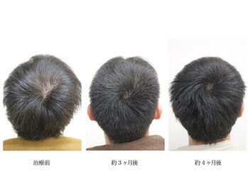 メンズ asc(men's asc)/ヘッドスパ2