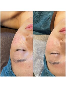 ベルーチェ(Beluce)/20代女性/長年悩んできたお悩み