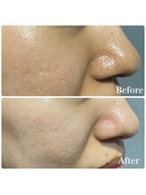 ラヴィアンクレール 梅田店(La vie en Clair)/◆ハーブピーリング◆