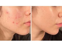 ザ モア(the MoRe)の雰囲気（国産ハーブの取扱い/芸能人御用達の3回でお肌が変わる劇的ハーブ）