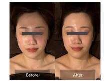 レーヴリゼ(Revelise)/頭蓋骨小顔矯正＋整顔マッサージ