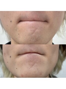 トゥインクル(Twinkle)/髭脱毛3回