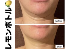 ブレア(Blair)/脂肪分解液レモンボトル