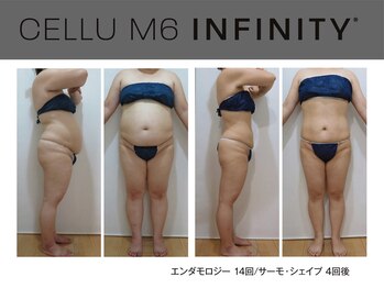 ビューティーリバース センター北店/エンダモロジーインフィニティ