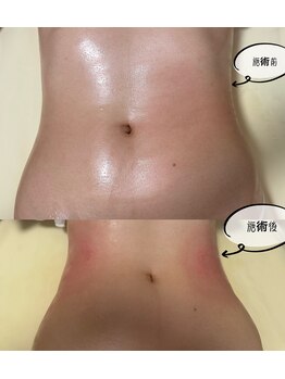 ミナミ/脂肪冷却＆エクシリス痩身効果UP