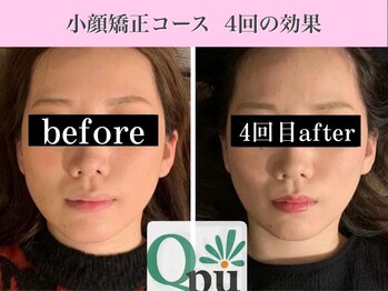キュープ 表参道店(Qpu)/小顔矯正4回コースの変化