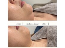 シルキーエービューティー(Silky A Beauty)の雰囲気（リフトアップや脂肪分解レモンボトルで自然な小顔を目指せます。）