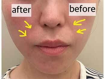 リラ(RILA)/サーモリフトbefore after