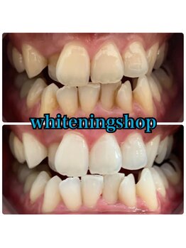 ホワイトニングショップ 武蔵小杉店/武蔵小杉ホワイトニング美白ケア