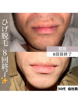 アカラビューティー(Akala Beauty)/ひげ脱毛〈８回終了！〉