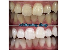 ホワイトニングショップ 所沢店/ホワイトニングショップ所沢店