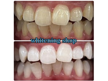 ホワイトニングショップ 所沢店/ホワイトニングショップ所沢店