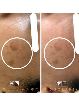 ソラリス(solaris)/シミケア