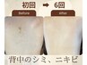 【背中ニキビケア・ざらつき改善】背中上部ハーブピーリング￥15400→￥11000