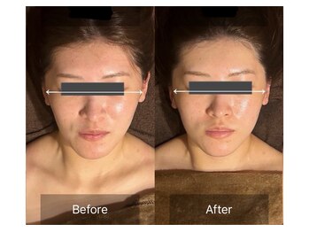 レーヴリゼ(Revelise)/頭蓋骨小顔矯正+整顔マッサージ