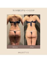 ブリエ(BRiLLER)/#ラジオ波コアヒートエステ