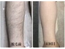 ホッコリ 段原店(HOKKORI)/全身脱毛