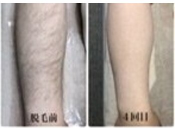 ホッコリ 段原店(HOKKORI)/全身脱毛