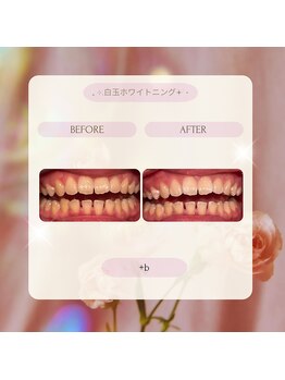 プラスビーセルフ(+b self)/ホワイトニングビフォーアフター