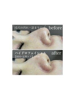 ステライチマルサン(stella.103)/ハイドロフェイシャル