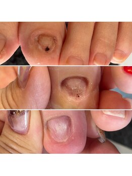 フット深爪矯正