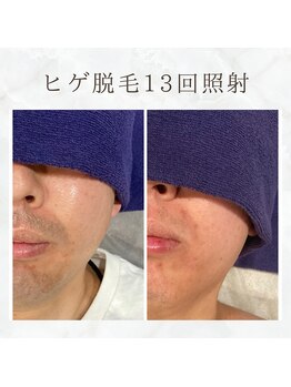 ボゴス(BOGOSS)/ヒゲ脱毛13回照射