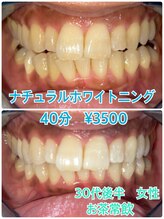 プラチナムビューティー 川口駅前店(PLATINUM BEAUTY)/お得に回数券で白い歯キープ！