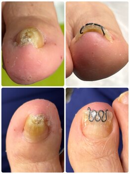 巻き爪矯正センター 沖縄 宜野湾/巻き爪矯正