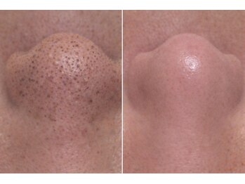 トータルサロンアイビーシー(トータルサロンIBC)の写真/黒ずみも開きもごっそり洗浄し、つるんと艶めく毛穴レス肌へ導く結果重視の徹底毛穴ケア!男女OK